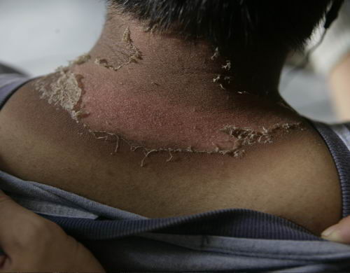 日晒伤是皮炎的一种典型类型之一,给患者的正常生活带来了严重的影响
